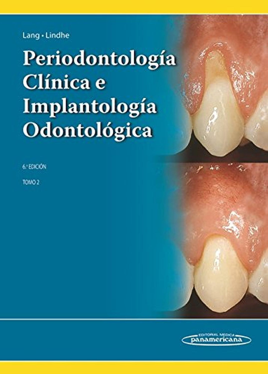 Periodontologia Clinica E Implantologia Odontologi: Tomo 2 – Cadabra ...